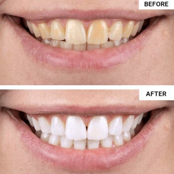 WellaWhite Teeth Whitening Kit customer~Miranda - week 3 – Florida, USA