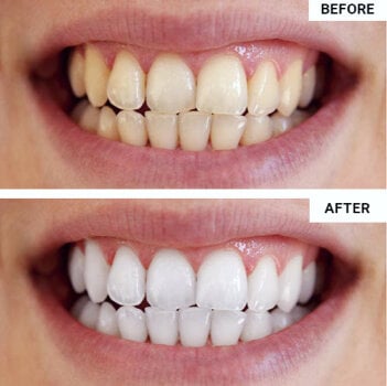 WellaWhite Teeth Whitening Kit customer~Lisa - week 10 – Illinois, USA
